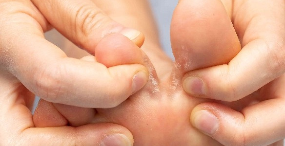 Grzybica stóp, najczęstszy problem polaków?