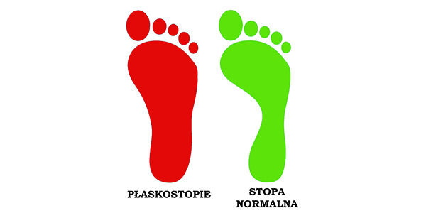 Płaskostopie u dzieci - przyczyny, objawy, leczenie, ćwiczenia