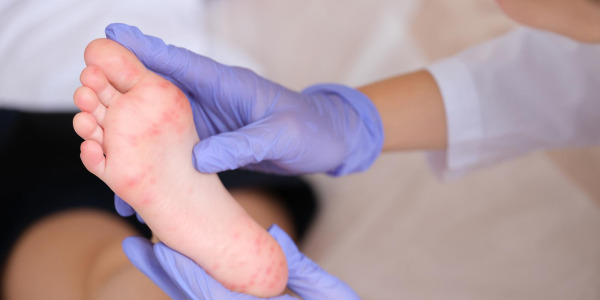 Kurzajki u dziecka na stopie: skąd się biorą i jak je leczyć?