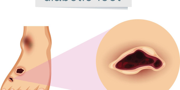 Zespół Stopy Cukrzycowej - co warto wiedzieć?